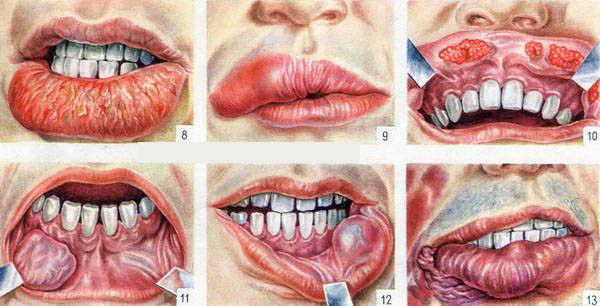 опухоли губы